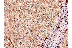 Immunohistochemistry of paraffin-embedded human liver cancer using ABIN7148300 at dilution of 1:100 (COMMD1 antibody  (AA 2-190))