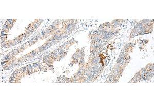 Immunohistochemistry of paraffin-embedded Human colorectal cancer tissue using GARNL3 Polyclonal Antibody at dilution of 1:60(x200) (GARNL3 antibody)