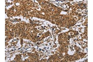 The image on the left is immunohistochemistry of paraffin-embedded Human gastric cancer tissue using ABIN7191086(IL31 Antibody) at dilution 1/20, on the right is treated with synthetic peptide. (IL-31 antibody)