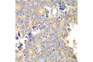 Immunohistochemistry of paraffin-embedded human prostate cancer using PICK1 antibody at dilution of 1:100 (x40 lens). (PICK1 antibody)