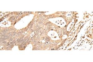 Immunohistochemistry of paraffin-embedded Human gastric cancer tissue using GRAP Polyclonal Antibody at dilution of 1:40(x200) (GRAP antibody)