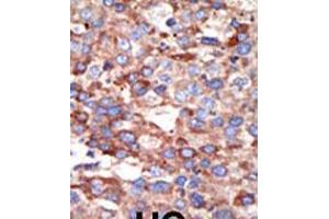 Formalin-fixed and paraffin-embedded human cancer tissue reacted with the primary antibody, which was peroxidase-conjugated to the secondary antibody, followed by DAB staining. (YY1 antibody  (AA 268-297))