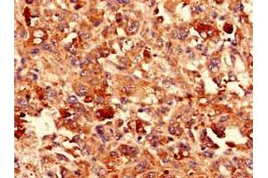 Immunohistochemistry analysis of human melanoma using ABIN7146228 at dilution of 1:100 (P-Cadherin antibody  (AA 117-360))