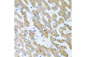 Immunohistochemistry of paraffin-embedded human liver injury using TOB2 antibody at dilution of 1:100 (x40 lens).