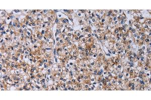 Immunohistochemistry of paraffin-embedded Human prostate cancer using CA4 Polyclonal Antibody at dilution of 1:30 (CA4 antibody)