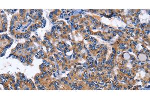 Immunohistochemistry of paraffin-embedded Human thyroid cancer using INHBC Polyclonal Antibody at dilution of 1:50 (INHBC antibody)