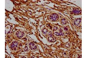 IHC image of ABIN7142837 diluted at 1:400 and staining in paraffin-embedded human breast cancer performed on a Leica BondTM system. (RPL7A antibody  (AA 2-138))