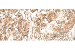 Immunohistochemistry of paraffin-embedded Human gastric cancer tissue using USP16 Polyclonal Antibody at dilution of 1:25(x200) (USP16 antibody)