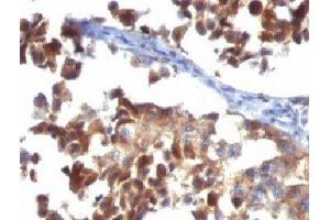 Formalin-fixed, paraffin-embedded human melanoma stained with LAMP3 antibody (LAMP3/968) (LAMP3 antibody)