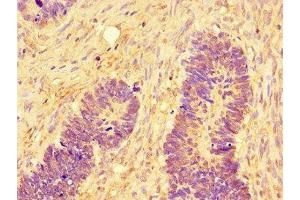 Immunohistochemistry of paraffin-embedded human ovarian cancer using ABIN7160009 at dilution of 1:100 (JNK antibody  (AA 5-300))