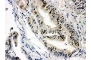 Anti-VDR Picoband antibody, IHC(P) IHC(P): Human Intestinal Cancer Tissue (Vitamin D Receptor antibody  (C-Term))