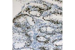 Immunohistochemical analysis of HNF4 alpha/gamma staining in human colon cancer formalin fixed paraffin embedded tissue section. (HNF4 alpha/gamma antibody)