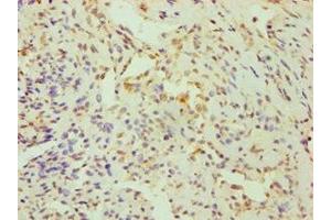 Immunohistochemistry of paraffin-embedded human breast cancer using ABIN7148700 at dilution of 1:100 (CRY1 antibody  (AA 507-586))