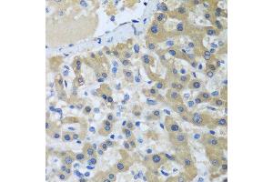 Immunohistochemistry of paraffin-embedded human liver cancer using XPC antibody at dilution of 1:100 (40x lens).