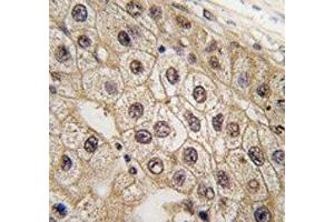 IHC analysis of FFPE human hepatocarcinoma tissue stained with PERK antibody (PERK antibody  (AA 148-175))