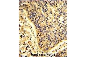 Formalin-fixed and paraffin-embedded human lung carcinoma with MyoGEF Antibody (N-term), which was peroxidase-conjugated to the secondary antibody, followed by DAB staining. (PLEKHG6 antibody  (N-Term))