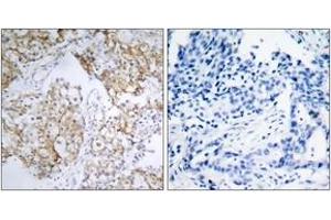 Immunohistochemistry analysis of paraffin-embedded human breast carcinoma, using IGF1R (Phospho-Tyr1161) Antibody.