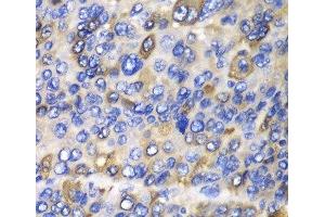 Immunohistochemistry of paraffin-embedded Human liver cancer using CES1 Polyclonal Antibody at dilution of 1:100 (40x lens). (CES1 antibody)