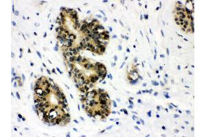Anti- JAB1 Picoband antibody, IHC(P) IHC(P): Human Mammary Cancer Tissue (COPS5 antibody  (AA 8-334))