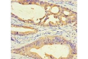 Immunohistochemistry of paraffin-embedded human colon cancer using ABIN7150645 at dilution of 1:100 (DMRTA1 antibody  (AA 201-504))