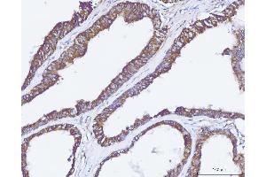 IHC analysis of Carbonic Anhydrase 9/CA9 using anti-Carbonic Anhydrase 9/CA9 antibody (ABIN7600076).