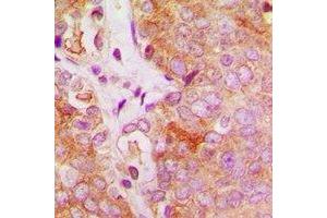 Immunohistochemical analysis of c-FER staining in human breast cancer formalin fixed paraffin embedded tissue section.