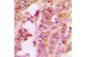 Immunohistochemical analysis of IRS1 staining in human breast cancer formalin fixed paraffin embedded tissue section. (IRS1 antibody  (Center))