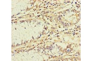 Immunohistochemistry of paraffin-embedded human colon cancer using ABIN7145543 at dilution of 1:100 (BCMO1 antibody  (AA 1-300))