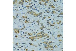 Immunohistochemistry of paraffin-embedded human gastric cancer using STX1A antibody. (STX1A antibody)