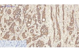 Immunohistochemistry of paraffin-embedded Human liver cancer tissue using AQP4 Monoclonal Antibody at dilution of 1:200. (Aquaporin 4 antibody)