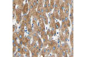 ABIN6266594 at 1/100 staining human liver carcinoma tissue sections by IHC-P. (MMP19 antibody  (N-Term))