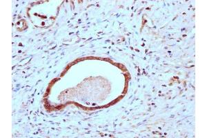 IHC image of ABIN7147892 diluted at 1:200 and staining in paraffin-embedded human gastric cancer performed on a Leica BondTM system. (Claudin 18 antibody  (AA 196-261))