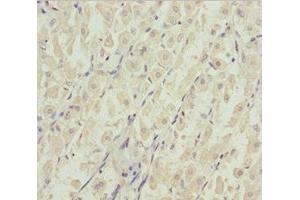 Immunohistochemistry of paraffin-embedded human gastric cancer using ABIN7144963 at dilution of 1:100 (DDX11 antibody  (AA 1-220))