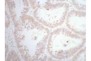 IHC staining of human rectal cancer tissue, diluted at 1:200. (CDX2 antibody)