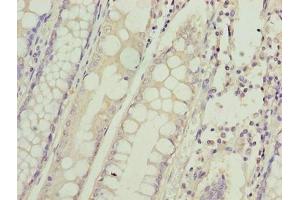 Immunohistochemistry of paraffin-embedded human colon cancer using ABIN7155160 at dilution of 1:100 (HIGD1B antibody  (AA 1-29))