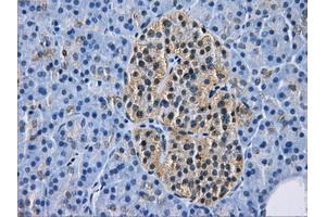 Immunohistochemical staining of paraffin-embedded Adenocarcinoma of breast tissue using anti-HDAC10 mouse monoclonal antibody.