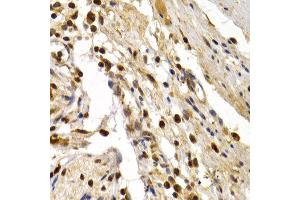 Immunohistochemistry of paraffin-embedded human colon damage using TFDP1 antibody at dilution of 1:200 (400x lens). (DP1 antibody)