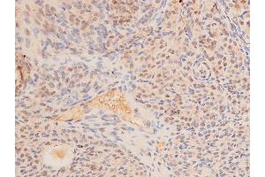 Immunohistochemistry (IHC) image for anti-Tumor Protein P53 (TP53) (acLys319) antibody (ABIN6254862)
