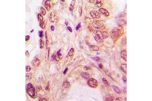 Immunohistochemical analysis of SF2 staining in human lung cancer formalin fixed paraffin embedded tissue section. (SRSF1 antibody)