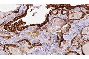 ABIN6267189 at 1/100 staining Human thyroid cancer tissue by IHC-P.