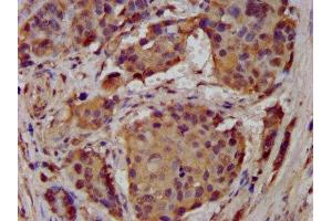 IHC image of ABIN7143000 diluted at 1:300 and staining in paraffin-embedded human pancreatic cancer performed on a Leica BondTM system.