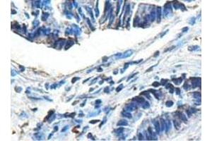 Immunohistochemical analysis of paraffin-embedded human colon carcinoma showing cytoplasmic staining with ACAD9 polyclonal antibody  at a 1 : 100 dilution. (ACAD9 antibody  (AA 1464-1642))