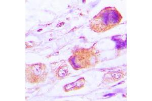 Immunohistochemical analysis of MRPL15 staining in human lung cancer formalin fixed paraffin embedded tissue section. (MRPL15 antibody  (Center))