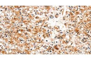 Immunohistochemistry of paraffin-embedded Human prostate cancer tissue using SLC25A12 Polyclonal Antibody at dilution 1:30 (SLC25A12 antibody)