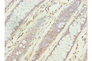 Immunohistochemistry of paraffin-embedded human colon cancer using ABIN7176126 at dilution of 1:100 (ZNF169 antibody  (AA 1-85))