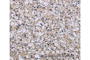 Immunohistochemistry of Human prostate cancer using MAPRE3 Polyclonal Antibody at dilution of 1:20