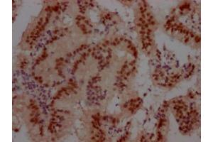 IHC image of ABIN7127438 diluted at 1:100 and staining in paraffin-embedded human prostate cancer performed on a Leica BondTM system. (Recombinant Cullin 3 antibody)