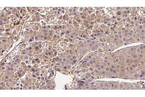 ABIN6272720 at 1/100 staining Human liver cancer tissue by IHC-P. (OR2B6 antibody  (Internal Region))