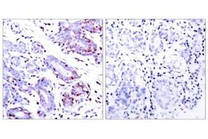 Immunohistochemical analysis of paraffin-embedded human breast carcinoma tissue using STAT1 (Ab-701) antibody (E021044). (STAT1 antibody)
