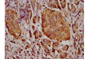 IHC image of ABIN7159545 diluted at 1:400 and staining in paraffin-embedded human pancreatic cancer performed on a Leica BondTM system. (MT3 antibody  (AA 1-68))